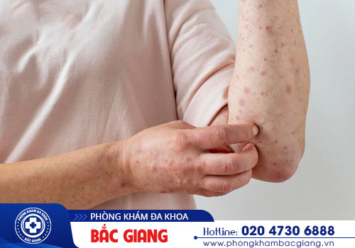 Bệnh giang mai - Triệu chứng nhận biết và phương pháp chẩn đoán chính xác