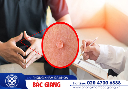 Các giai đoạn của sùi mào gà ở nam và nữ - Triệu chứng cụ thể
