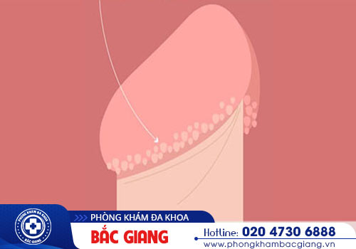 Chữa hạt ngọc dương vật nam giới thế nào?