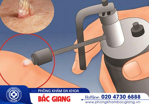 Chữa HPV bằng phương pháp xịt nitơ lỏng thế nào?
