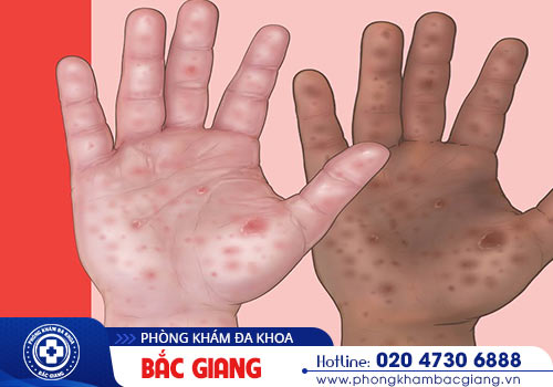 Dấu hiệu của bệnh giang mai qua từng giai đoạn chớ xem thường