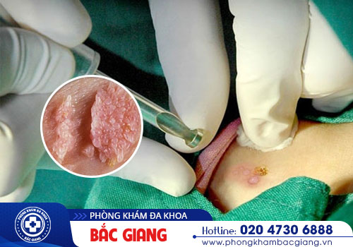Đốt sùi mào gà có chữa khỏi bệnh được không?