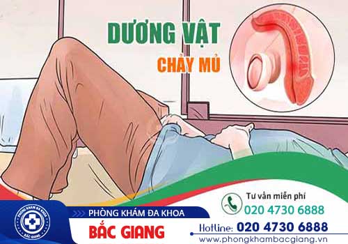 Dương vật chảy mủ - Cảnh giác với những bệnh lý nguy hiểm