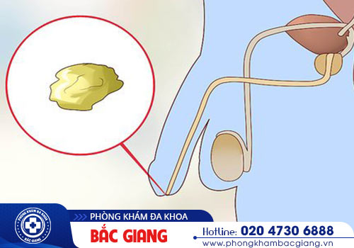 Dương vật chảy mủ màu vàng cảnh báo bệnh nguy hiểm ở nam giới
