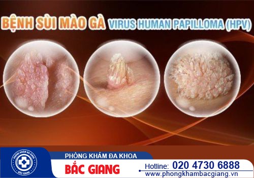 Nguyên nhân bị sùi mào gà ở nam giới? Phương pháp nào điều trị hiệu quả?