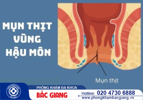 Nổi mụn ở hậu môn là bị bệnh gì? Cách điều trị hiệu quả hiện nay
