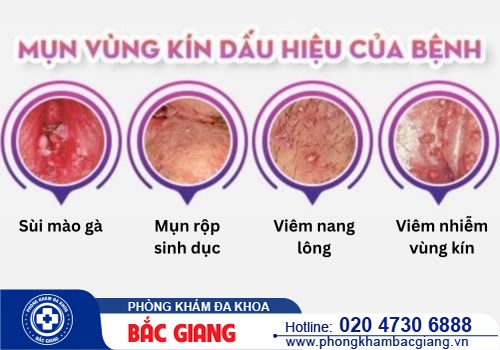 Mụn vùng kín là bệnh gì? Mọc mụn vùng kín phải làm sao?