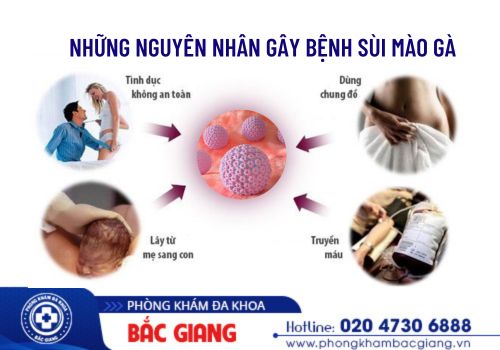 Điểm danh những nguyên nhân gây sùi mào gà