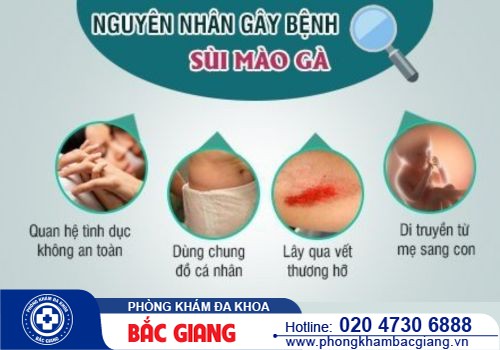 Tại sao bị bệnh sùi mào gà? Phương pháp nào điều trị hiệu quả?