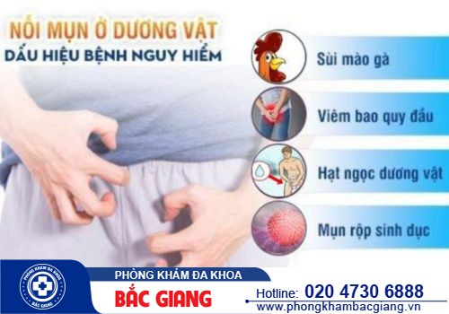 Mụn sinh dục có phải là bệnh xã hội? Cách điều trị ra sao?