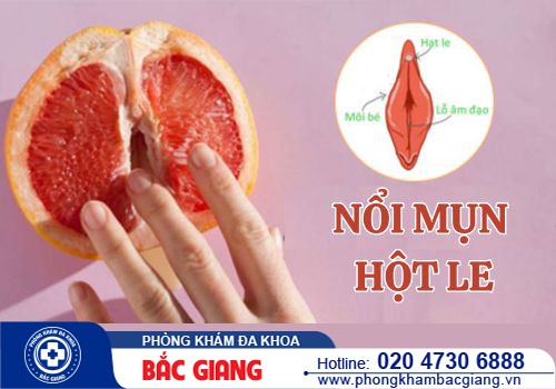 Nổi mụn ở hột le nguyên nhân do đâu? Điều trị như thế nào?