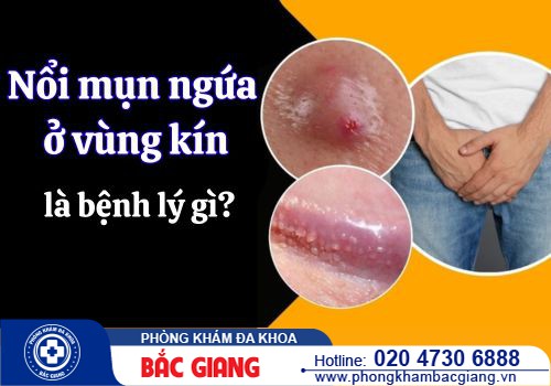 Nổi mụn ngứa ở vùng kín là bệnh lý gì? Cách điều trị ra sao?