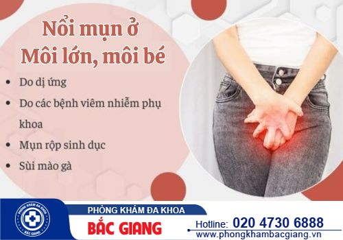 Các loại mụn ở môi lớn môi bé - Phương pháp điều trị hiệu quả