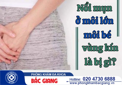 Nổi mụn ở môi lớn môi bé vùng kín là bị gì? Cách điều trị hiệu quả