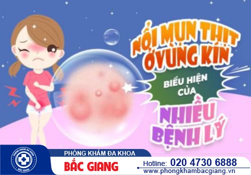 Mụn thịt ở cửa mình có nguy hiểm không? Điều trị bằng cách nào?