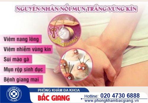 Vùng kín nổi mụn trắng: Nguyên nhân và cách điều trị