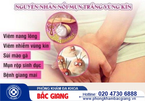 Âm đạo nổi mụn trắng có phải dấu hiệu mắc bệnh xã hội?