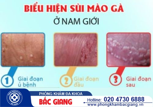 Cách nhận biết bệnh sùi mào gà ở nam và phương pháp điều trị hiệu quả