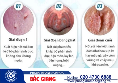 Sùi mào gà ở nam giai đoạn đầu có biểu hiện gì? Điều trị ra sao?