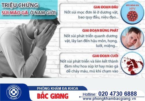 Dấu hiệu bệnh sùi mào gà ở nam giới? Chi phí điều trị có đắt không?