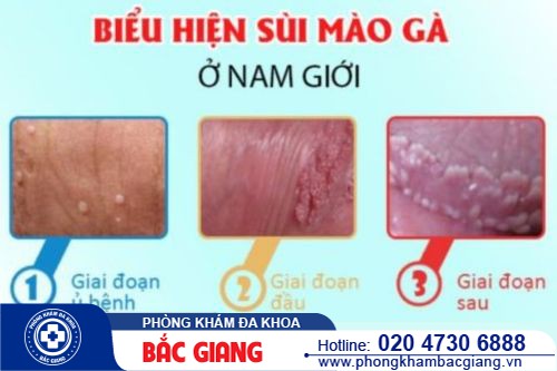 Sùi mào gà ở nam có biểu hiện gì? Cách chữa bệnh sùi mào gà ở nam giới