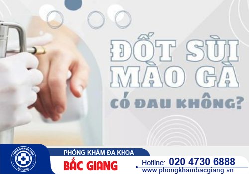 Đốt sùi mào gà có đau không? Nên đốt sùi mào gà ở đâu?