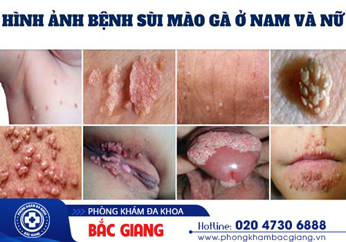 ngứa bộ phận sinh dục