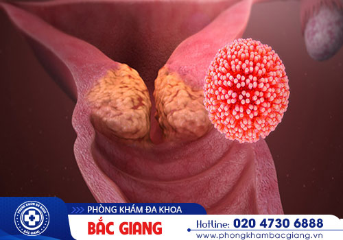 Cẩn thận khi mắc sùi mào gà âm đạo