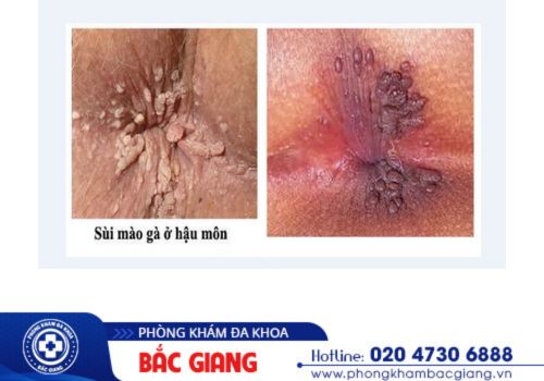 nổi mụn hậu môn