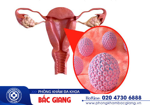 Sùi mào gà tử cung ở nữ giới nguy hiểm không?
