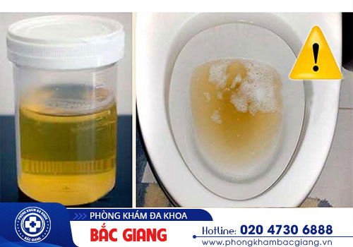 Tiểu ra mủ là bệnh gì? Cách điều trị hiệu quả