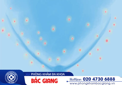 Mụn âm đạo tăng nguy cơ nguy hiểm đến sức khỏe nữ giới